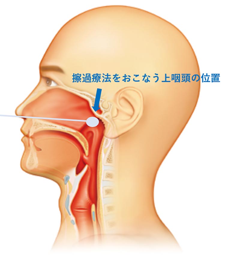 擦過療法をおこなう上咽頭の位置
