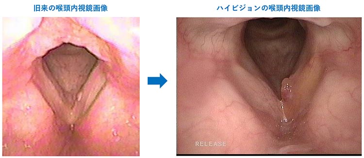 ハイビジョンの喉頭内視鏡画像