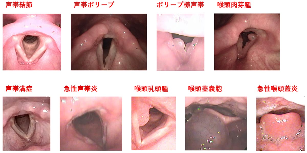 いろいろな喉頭（声帯、喉頭蓋）の病気
